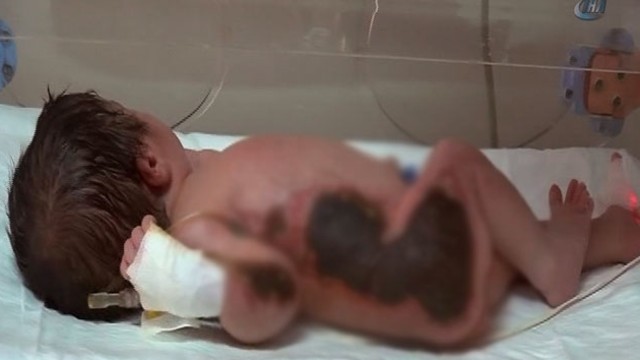 Photo of Hastanede skandal:Yeni doğan bebeği ısıtacağız diye yaktılar!